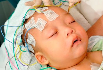 Exame EEG Mapeamento cerebral Exame EEG Mapeamento cerebral